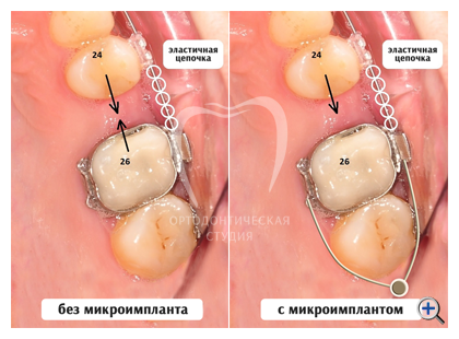 Сепарация зубов при ношении брекетов — последствия и отзывы!