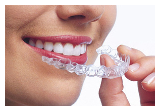 Отбеливание зубов в домашних условиях — самый лучший способ