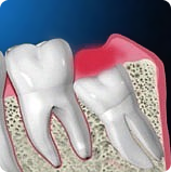 Сколько зубов можно удалять одновременно?