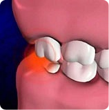 ретинированный зуб