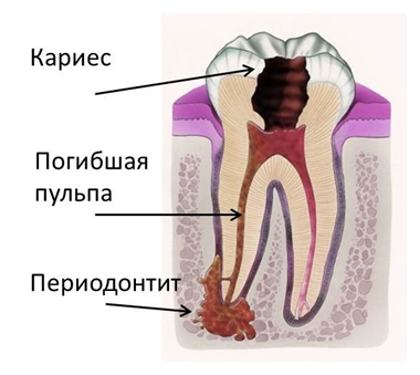 Киста зуба, лечение кисты зуба в Харькове.