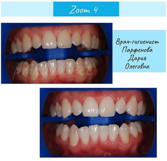 Отбеливание зубов zoom калуга характеристики зубных щеток