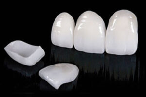 Керамические коронки на зубы