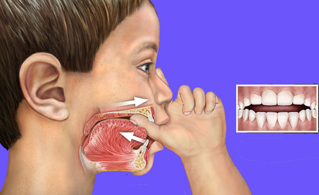 Дистальный Прикус 32 Зубов - Лечение У Детей И Взрослых