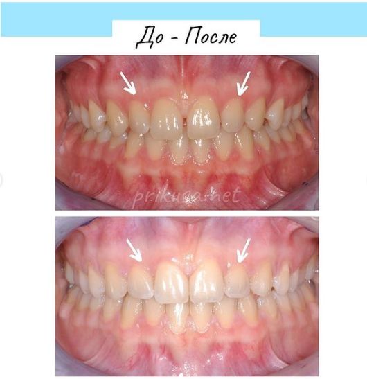 Щель между зубами (диастема)