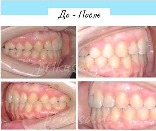 Трема - щель между боковых зубов