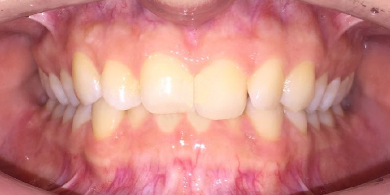 Пример ортодонтического лечения. Пациент 1. Фото 2 